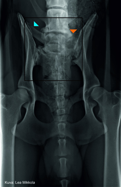 Lumbosacral transitional vertebrae (LTV) - Lohen tutkimusryhmä